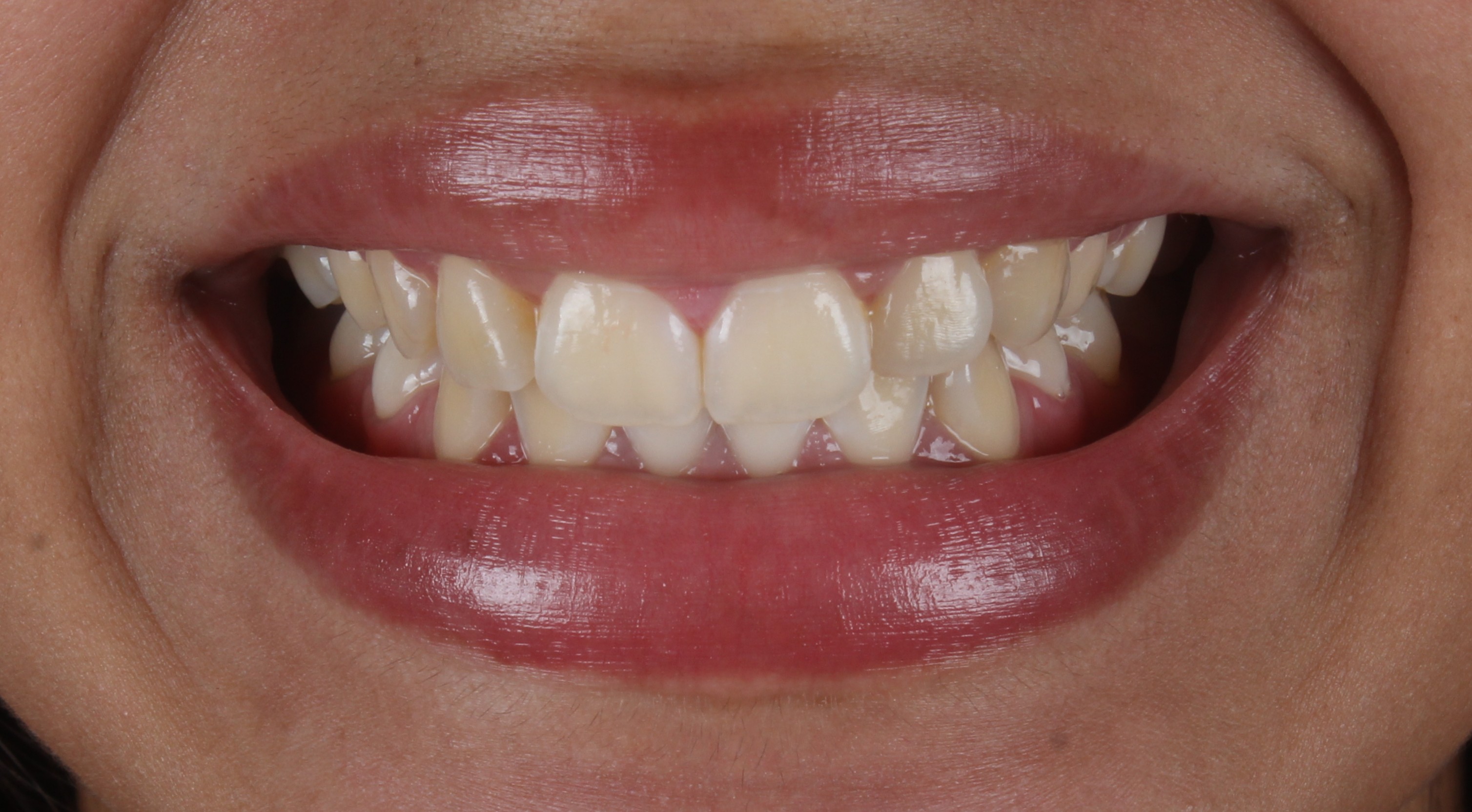 Antes do clareamento dental